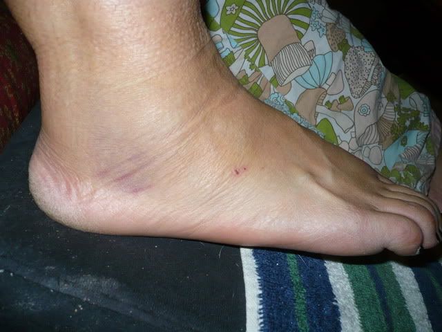 Right foot Busted up